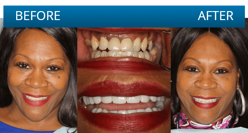 Before and after dental treatment result