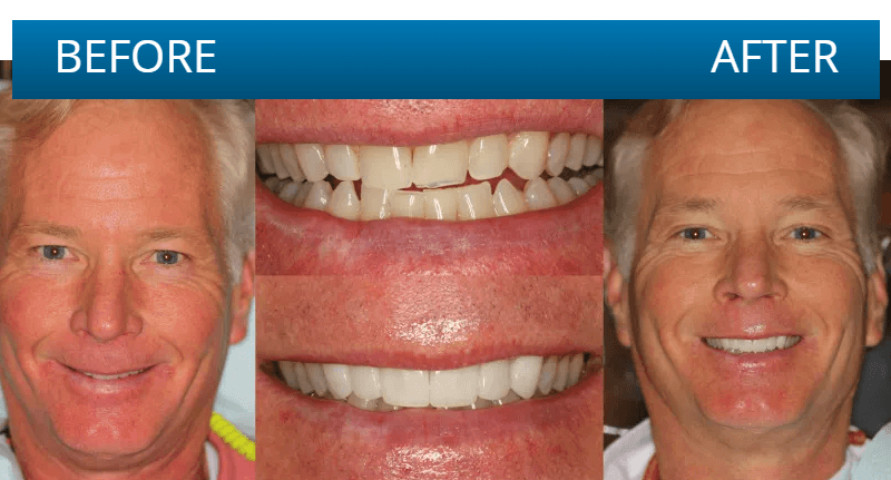 Before and after dental treatment result